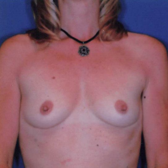 Breast Augmentation - Case 1975 - Before