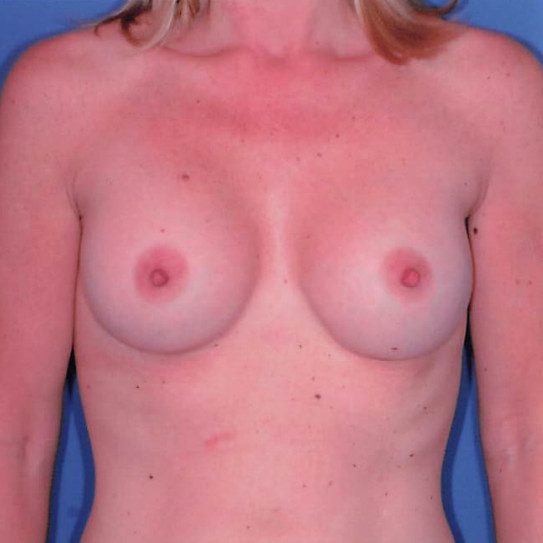 Breast Augmentation Patient Photo - Case 1975 - after view-0