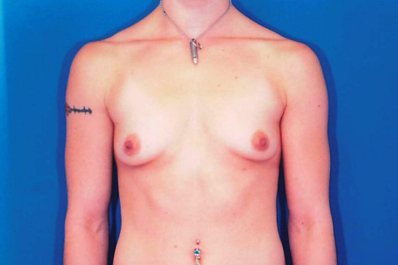 Breast Augmentation Patient Photo - Case 1980 - before view-