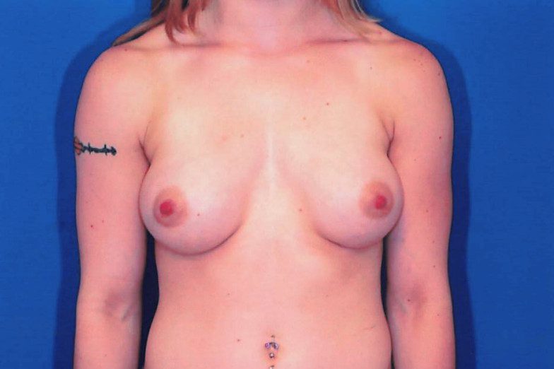 Breast Augmentation Patient Photo - Case 1980 - after view-0