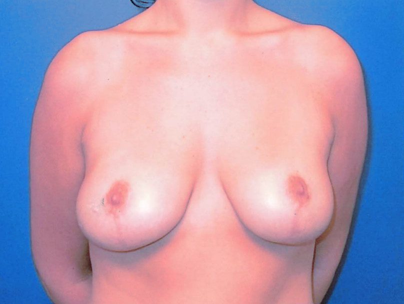 Breast Lift Patient Photo - Case 1990 - after view
