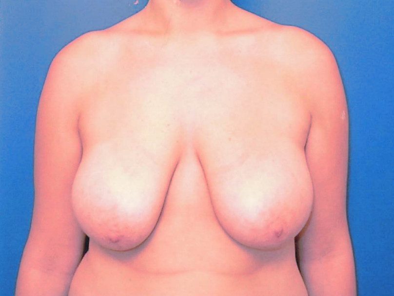 Breast Lift Patient Photo - Case 1990 - before view-