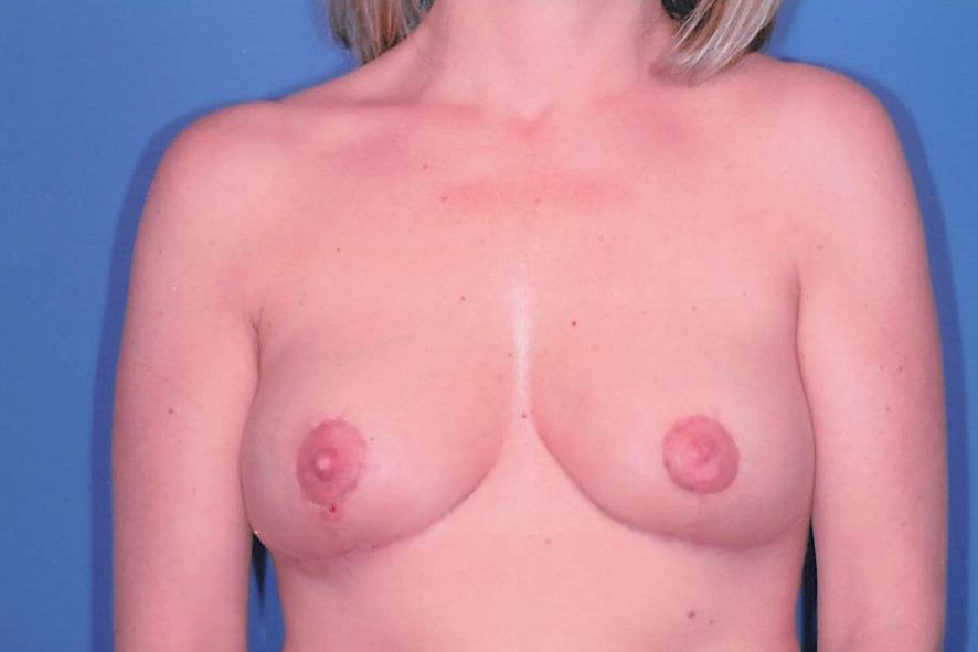 Breast Reduction Patient Photo - Case 2004 - after view-0