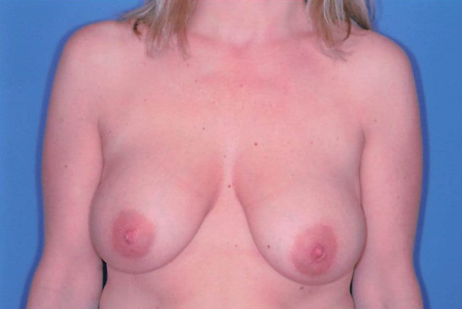 Breast Reduction Patient Photo - Case 2004 - before view-0