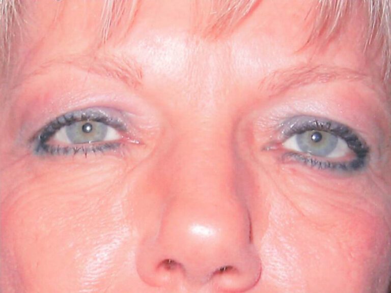 Eyelid Surgery - Case 2009 - Before