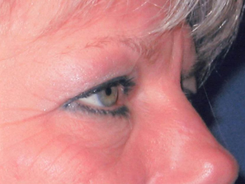 Eyelid Surgery Patient Photo - Case 2009 - before view-1