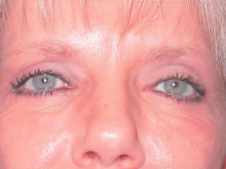 Eyelid Surgery - Case 2009 - After