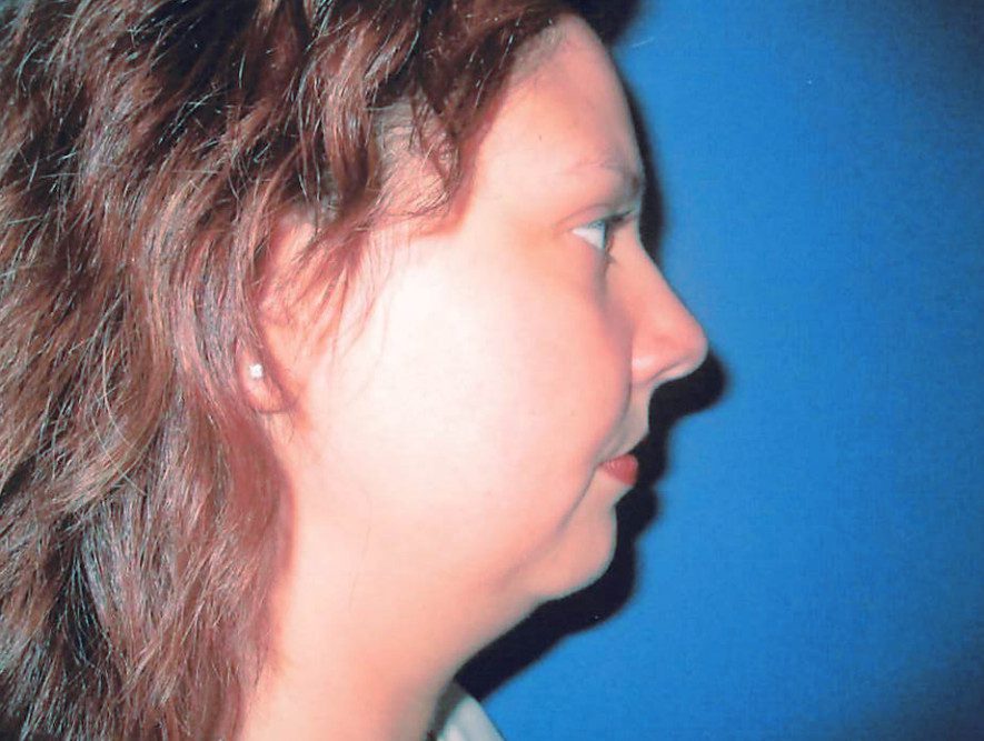 Liposuction Patient Photo - Case 2026 - before view-0