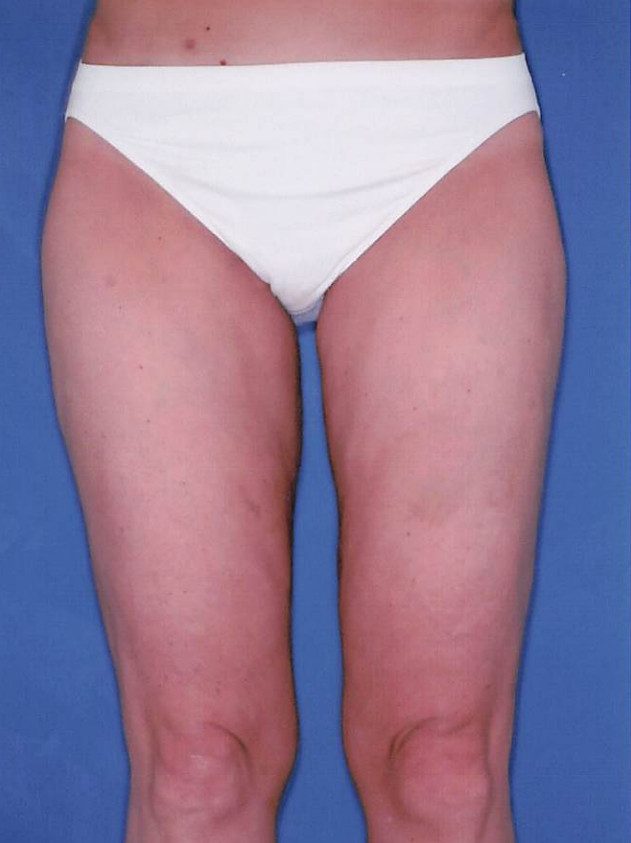 Liposuction - Case 2031 - After