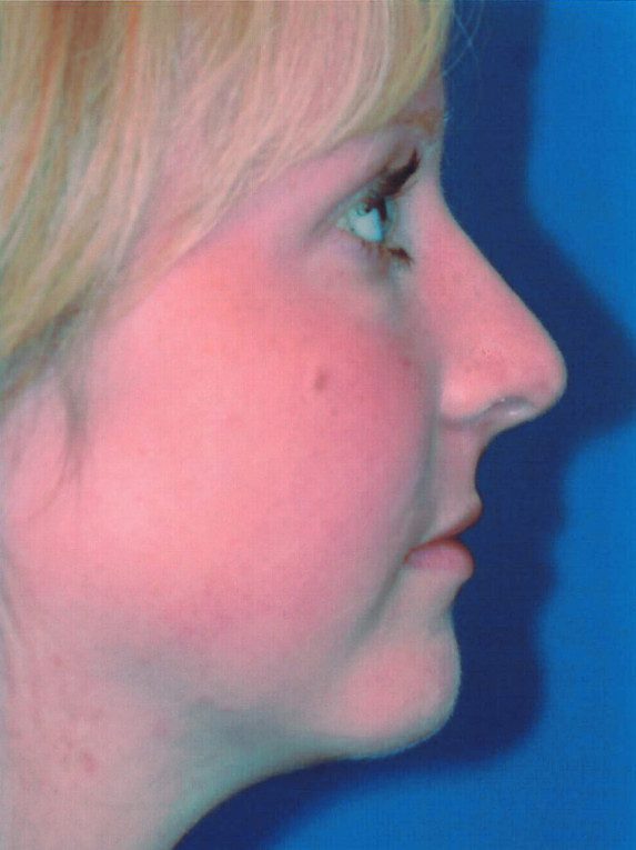 Rhinoplasty Patient Photo - Case 2036 - after view