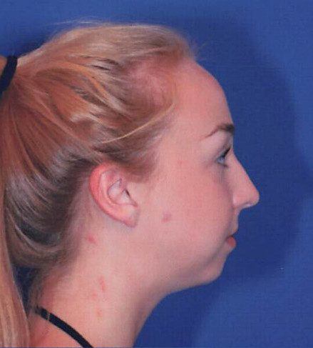 Rhinoplasty Patient Photo - Case 2039 - before view-