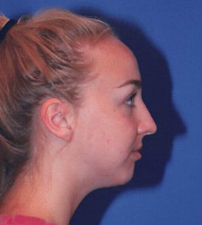 Rhinoplasty Patient Photo - Case 2039 - after view-0