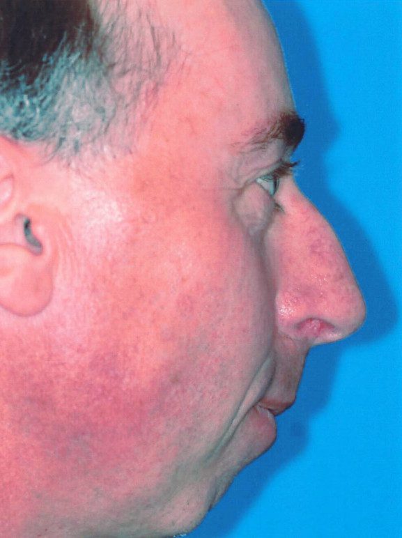 Rhinoplasty Patient Photo - Case 2046 - before view-