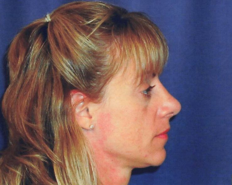 Rhinoplasty Patient Photo - Case 2049 - after view-0