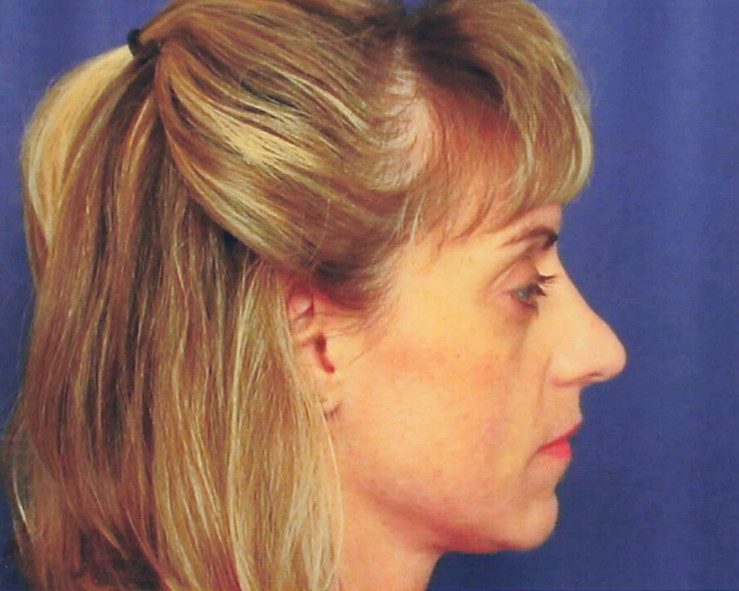 Rhinoplasty Patient Photo - Case 2049 - before view-