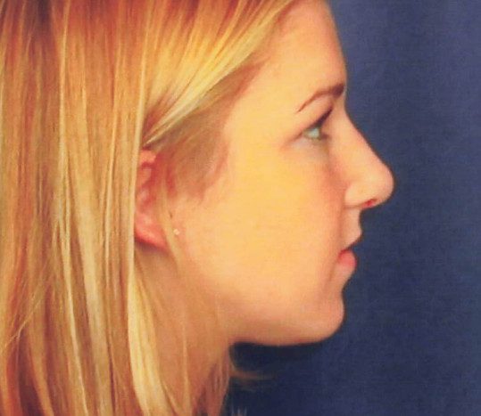 Rhinoplasty Patient Photo - Case 2054 - after view