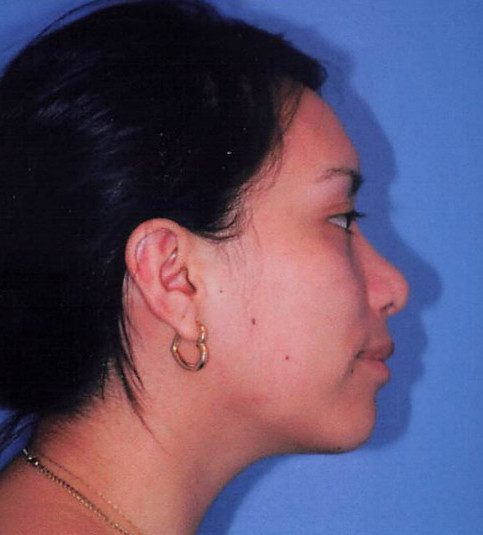 Rhinoplasty Patient Photo - Case 2059 - after view-0