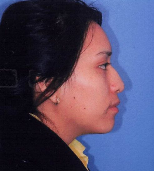Rhinoplasty Patient Photo - Case 2059 - before view-
