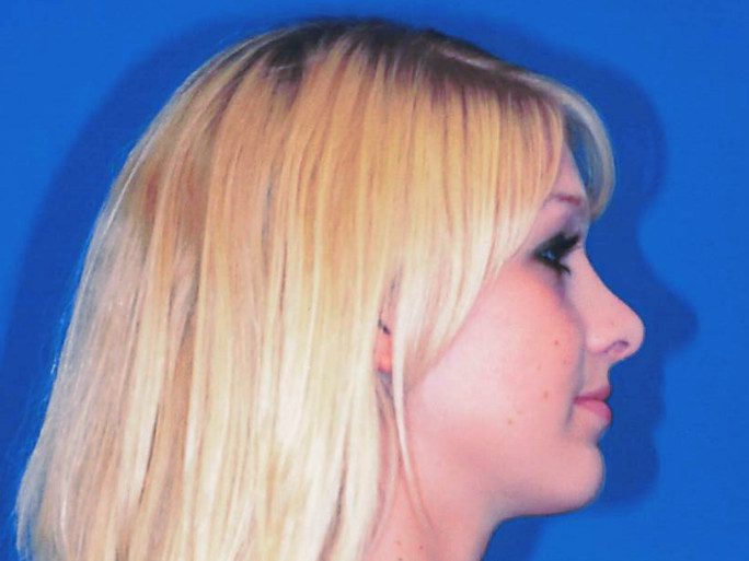 Rhinoplasty Patient Photo - Case 2066 - after view-0