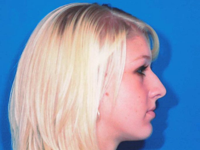 Rhinoplasty Patient Photo - Case 2066 - before view-