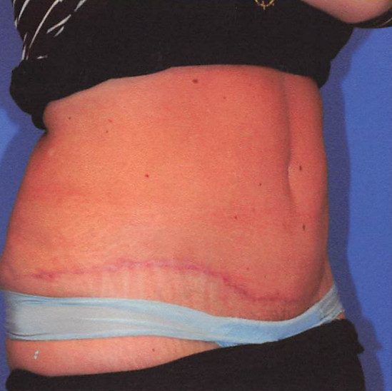 Abdominoplasty Patient Photo - Case 2071 - after view-1
