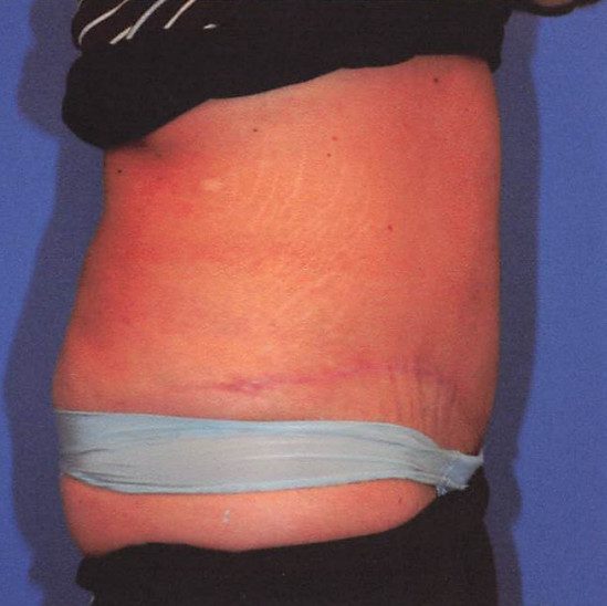 Abdominoplasty Patient Photo - Case 2071 - after view-2