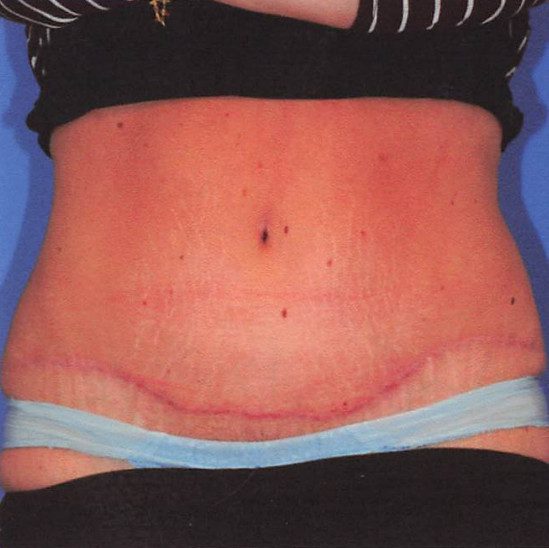 Abdominoplasty Patient Photo - Case 2071 - after view-0