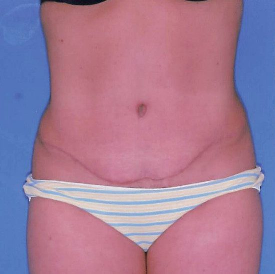 Abdominoplasty Patient Photo - Case 2078 - after view