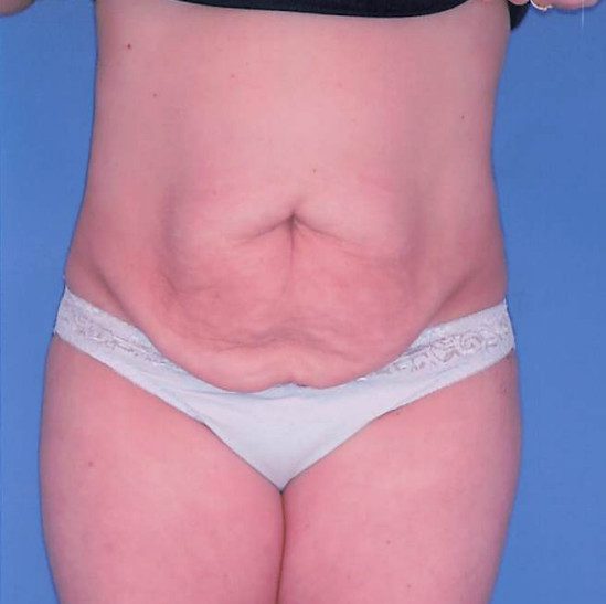 Abdominoplasty Patient Photo - Case 2078 - before view-